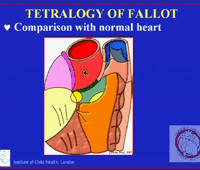 Video 3 - Compare Normal to ToF