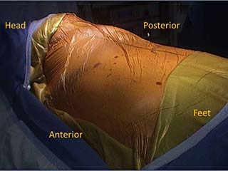 Camera port and working incision
