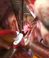 Bicameral Repair of Ruptured Sinus of Valsalva Aneurysm