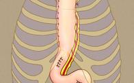 Transhiatal esophagectomy