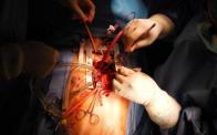 Heart Surgery