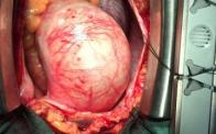 Giant aortic aneurysm, more than 80 mm wide. It took two sizes aortic prothesis to repair avoiding incongruence.
