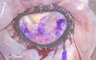 Endoscopic Mitral Valve Repair