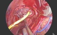 Endoscopic Tricuspid Valve Repair