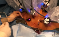 Robotic Mitral Valve Repair T. Sloane Guy, MD