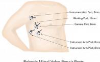 TotallyEndoscopic Robotic Mitral Valve Repair