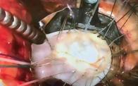 Minimally Invasive Mitral Exposure